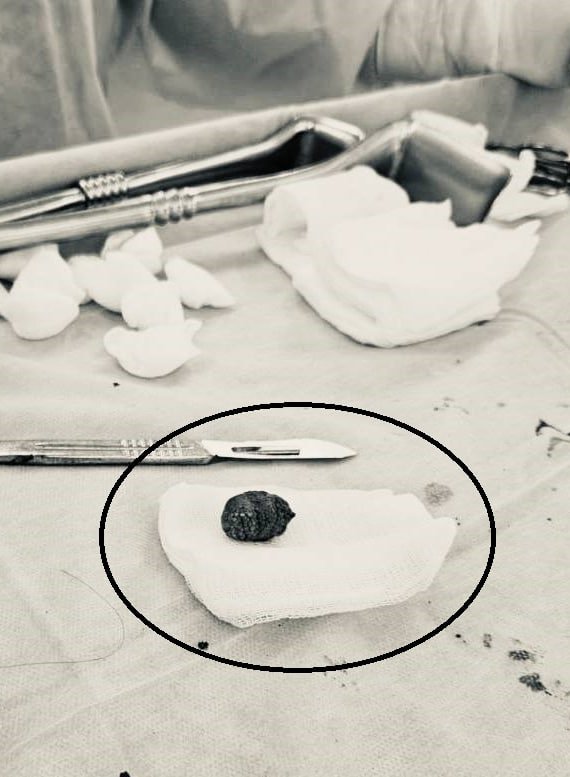 Долгопрудненские хирурги помогли пациенту с редким расположением камня, вышедшего за пределы желчного пузыря